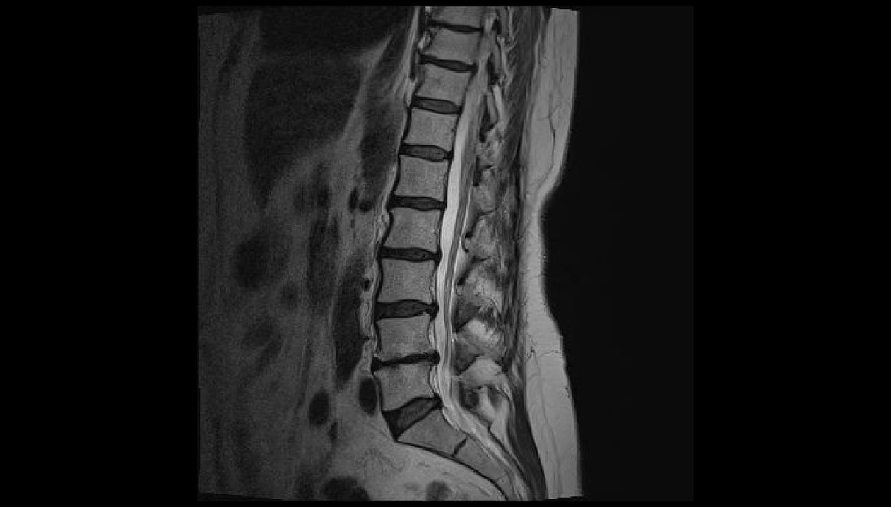 diagnóstico de dolor de espalda en la región lumbar