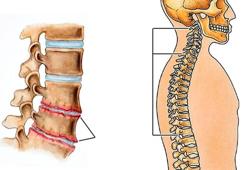 la curvatura de la columna provoca dolor de espalda