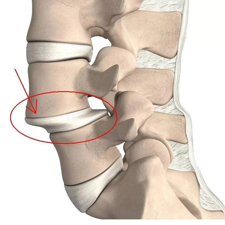 lesiones vertebrales