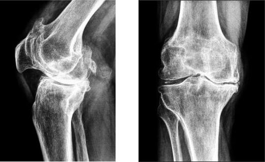 Gonartrosis de la rodilla en la radiografía