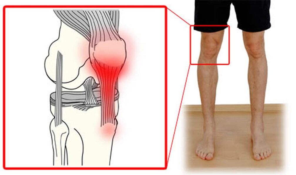 Tendinitis - inflamación de los tendones en la articulación de la rodilla