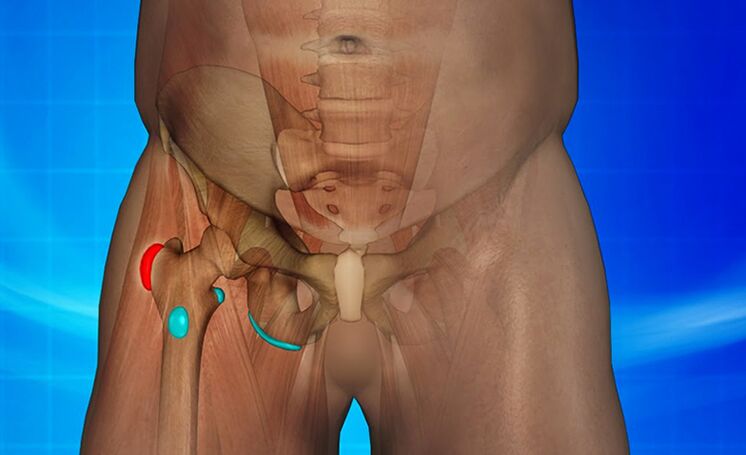 inflamación de la articulación de la cadera como causa del dolor