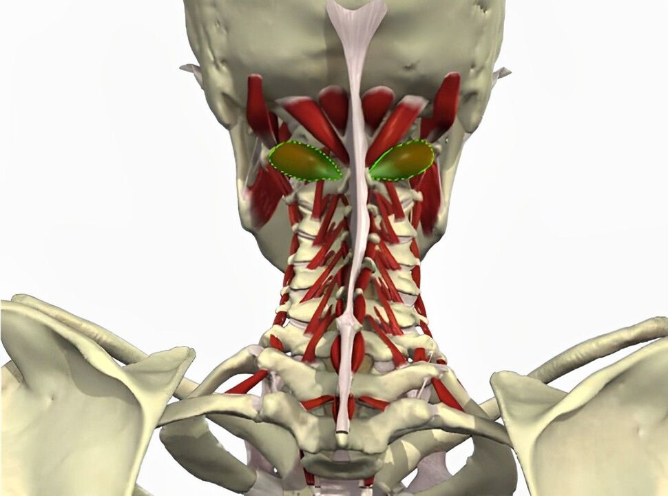 síndrome de la arteria vertebral