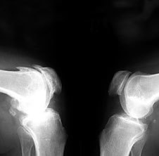 La osteoartritis en ray