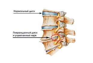 Los síntomas de la enfermedad degenerativa del disco cervical