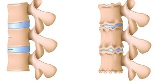 cómo reconocer la presencia de osteocondrosis de la columna lumbar