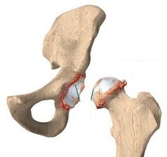 causas de artrosis de la articulación de la cadera