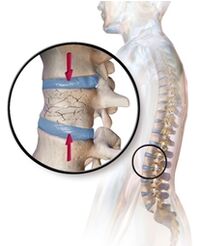 La osteoporosis provoca dolor de espalda en la región lumbar. 